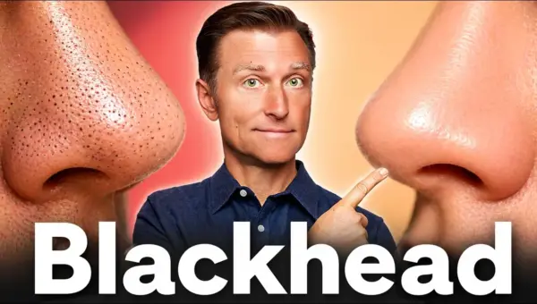 Clear Skin Secret: Reduce Sugar for Fewer Blackheads