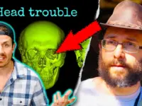 Skull ‘Melting’ Mystery Solved: Rare Disease Ravaged Man