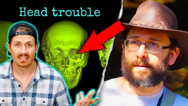 Skull ‘Melting’ Mystery Solved: Rare Disease Ravaged Man