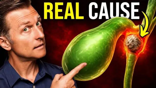 Stop Gallstones: Low-Fat Diets May Trigger Them